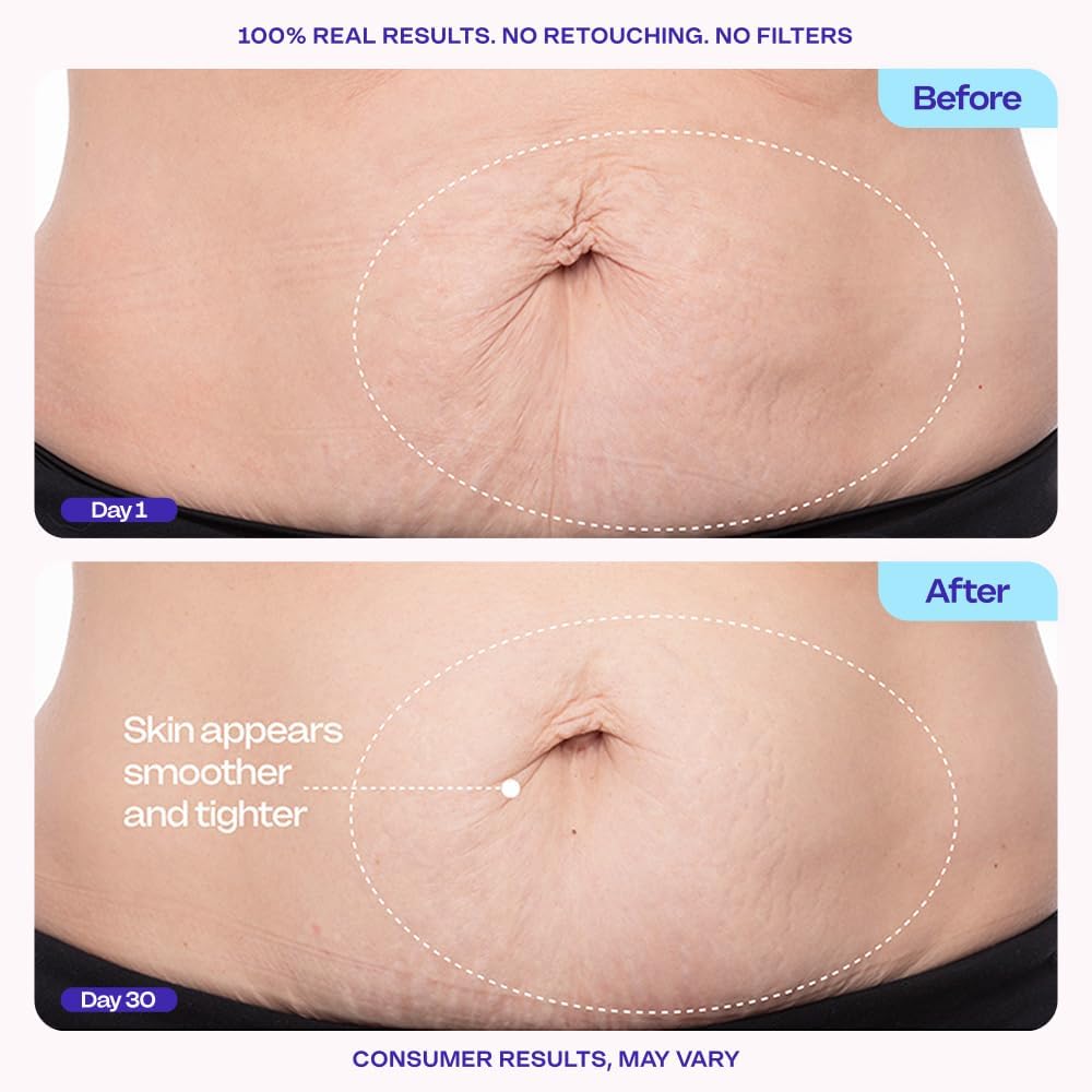 goPure Firming Belly Cream - Dermatologist-Developed Moisturizer with MicroTight4 Complex - Green Microalgae, Longan Seed, Copper Tripeptide-1 - Quick Absorbing for Smooth, Firmer-Looking Skin