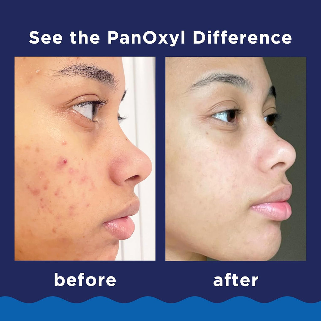 PanOxyl 10% Benzoyl Peroxide Acne Foaming Wash, Maximum Strength, Daily Acne-Fighting Face and Body Cleanser, Face Wash to Clear, Treat and Prevent Acne Pimples and Stubborn Breakouts, 5.5 Oz Tube