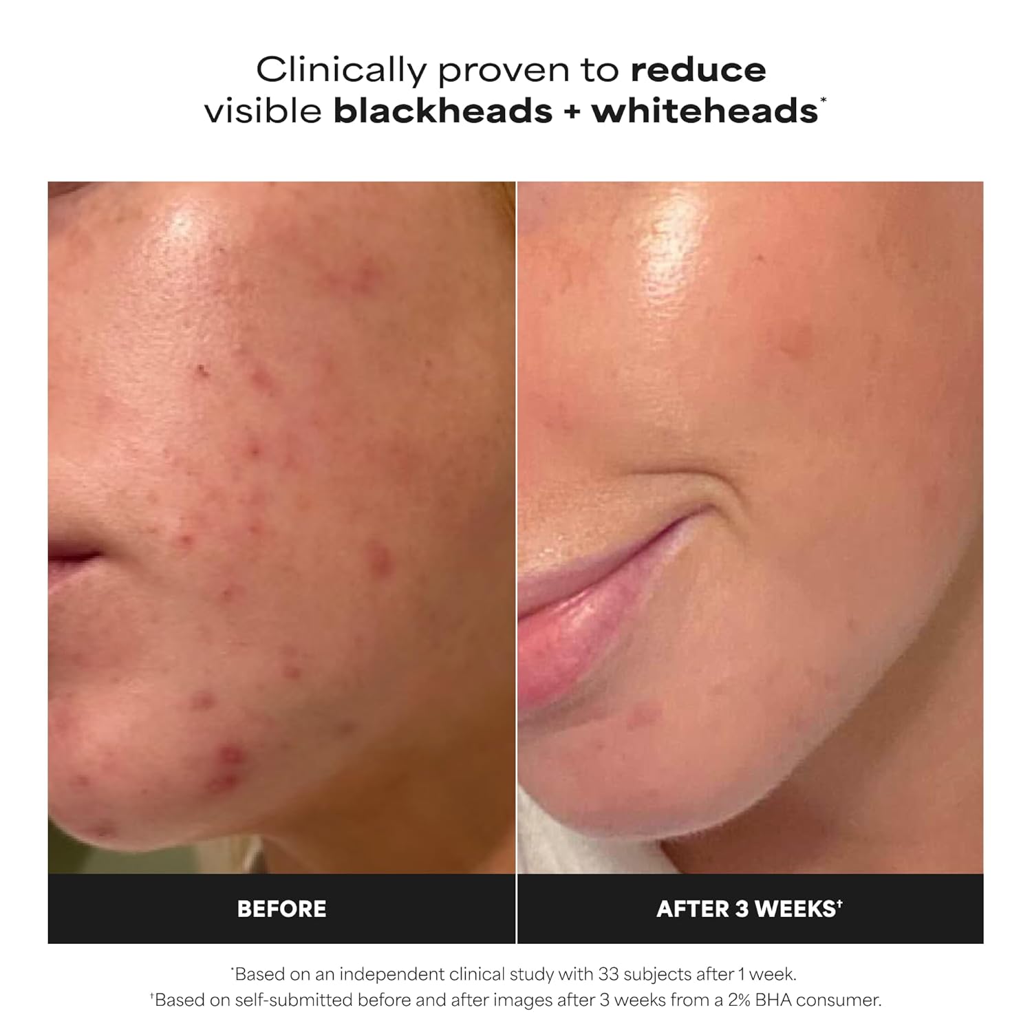 Paula's Choice SKIN PERFECTING 2% BHA Liquid Exfoliant with Salicylic Acid, Facial Polish for Enlarged Pores, Wrinkles & Fine Lines, Suitable for Blackhead-Prone Skin, Fragrance-Free